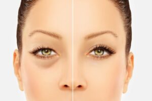 Découvrez mon expérience avec la blépharoplastie sur Nice !